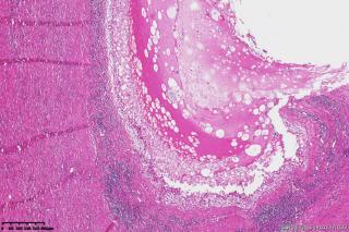 小肠系膜包块图17