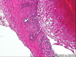 请教老师，食管黏膜，够不够低级别？图1
