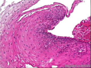请教老师，食管黏膜，够不够低级别？图6