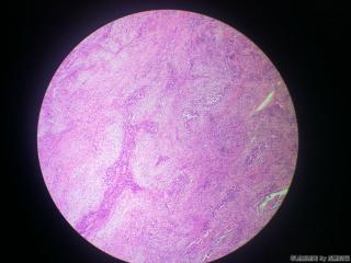 根尖肉芽肿（上皮细胞一般增生or肿瘤）图14