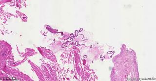 卵巢黏液性肿瘤，请教这些区域能否达到交界性?图3