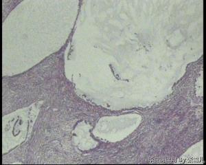 左侧卵巢，交界性囊腺瘤吗？图2