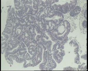 请老师看看，直肠绒毛管状腺瘤，局灶够高级别吗？图6