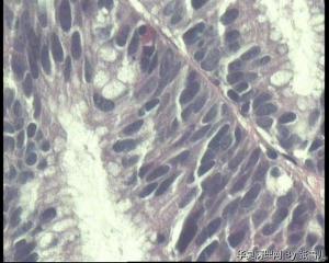请老师看看，直肠绒毛管状腺瘤，局灶够高级别吗？图13