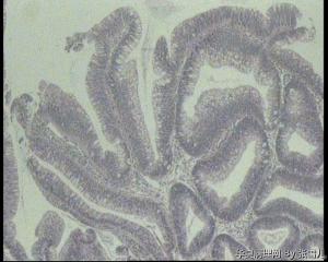 请老师看看，直肠绒毛管状腺瘤，局灶够高级别吗？图3