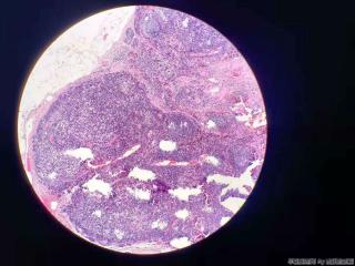 胆囊浆膜下见一淋巴结图2