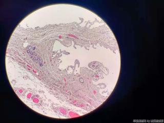 胆囊浆膜下见一淋巴结图3