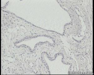 前列腺这些腺体，腺腔皱襞消失，是萎缩性改变吗？图9