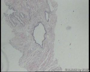前列腺这些腺体，腺腔皱襞消失，是萎缩性改变吗？图3