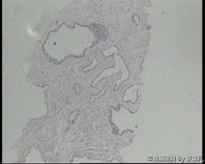 前列腺这些腺体，腺腔皱襞消失，是萎缩性改变吗？图5