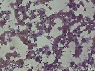 甲状腺结节细针穿刺涂片图21