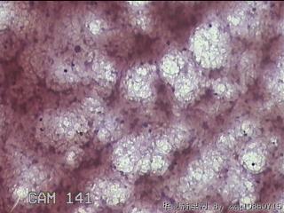 甲状腺结节细针穿刺涂片图11