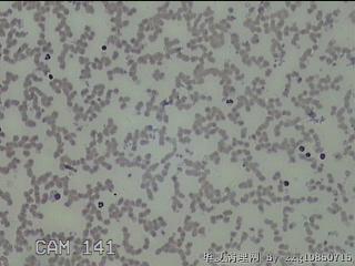 甲状腺结节细针穿刺涂片图9