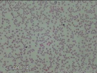 甲状腺结节细针穿刺涂片图12