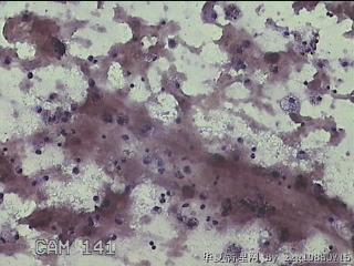 甲状腺结节细针穿刺涂片图24