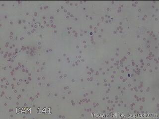 甲状腺结节细针穿刺涂片图15