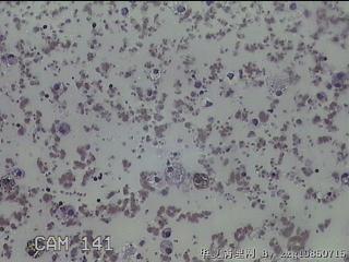 甲状腺结节细针穿刺涂片图25