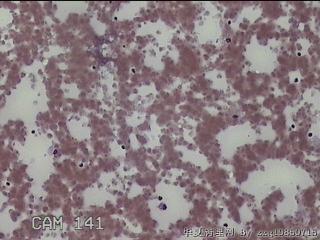 甲状腺结节细针穿刺涂片图7