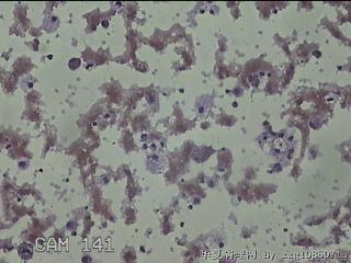 甲状腺结节细针穿刺涂片图30