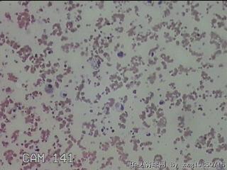 甲状腺结节细针穿刺涂片图31