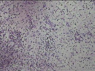 双侧鼻腔新生物图26