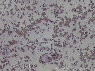 甲状腺结节细针穿刺涂片图32