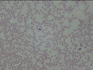 甲状腺结节细针穿刺涂片图13