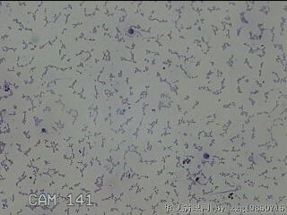 膝关节腔积液5ml图14