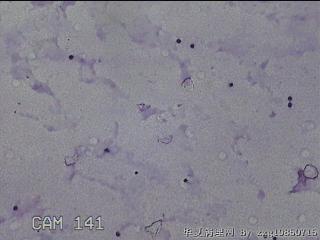 膝关节腔积液11ml图6