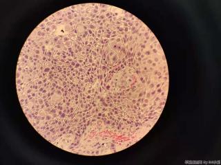 高分化鳞癌？图2