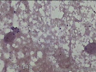 右侧甲状腺细针穿刺涂片图29