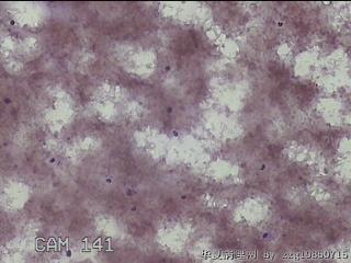 右侧甲状腺细针穿刺涂片图23