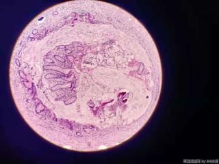 阑尾腔内见粘液，符合慢性炎改变吗？图2