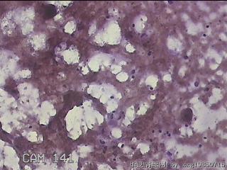 右侧甲状腺细针穿刺涂片图5