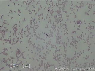 右侧甲状腺细针穿刺涂片图1