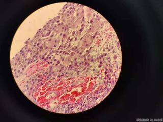 高分化鳞癌？图7