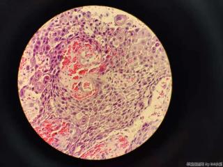高分化鳞癌？图11