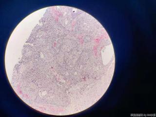 高分化鳞癌？图6