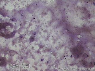 右侧甲状腺细针穿刺涂片图16