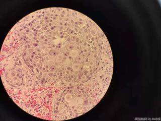 高分化鳞癌？图8