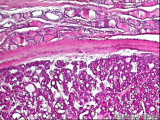请教老师，甲状腺腺瘤？图18