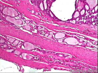 请教老师，甲状腺腺瘤？图3