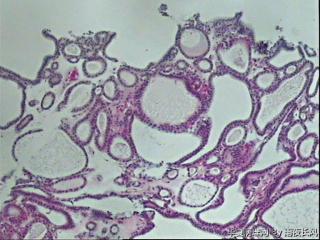 请教老师，甲状腺腺瘤？图23
