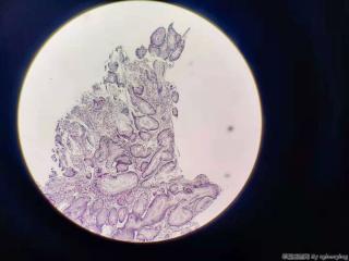 升结肠肿物 内镜取活检图2