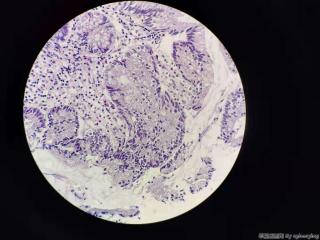 升结肠肿物 内镜取活检图6