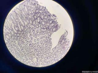 增生性息肉伴低级别？图2