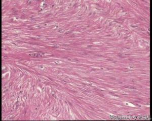 请老师看看，直肠息肉，报平滑肌瘤，还是间质瘤图13
