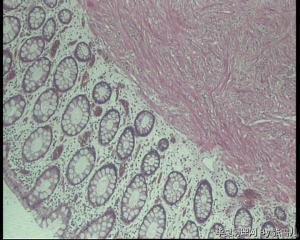 请老师看看，直肠息肉，报平滑肌瘤，还是间质瘤图1