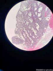 带节育环，功血，看着像妊娠期内膜图6