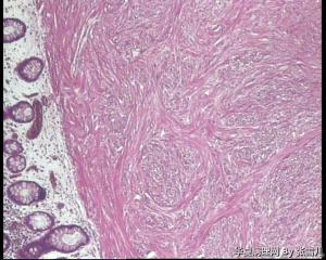 请老师看看，直肠息肉，报平滑肌瘤，还是间质瘤图3
